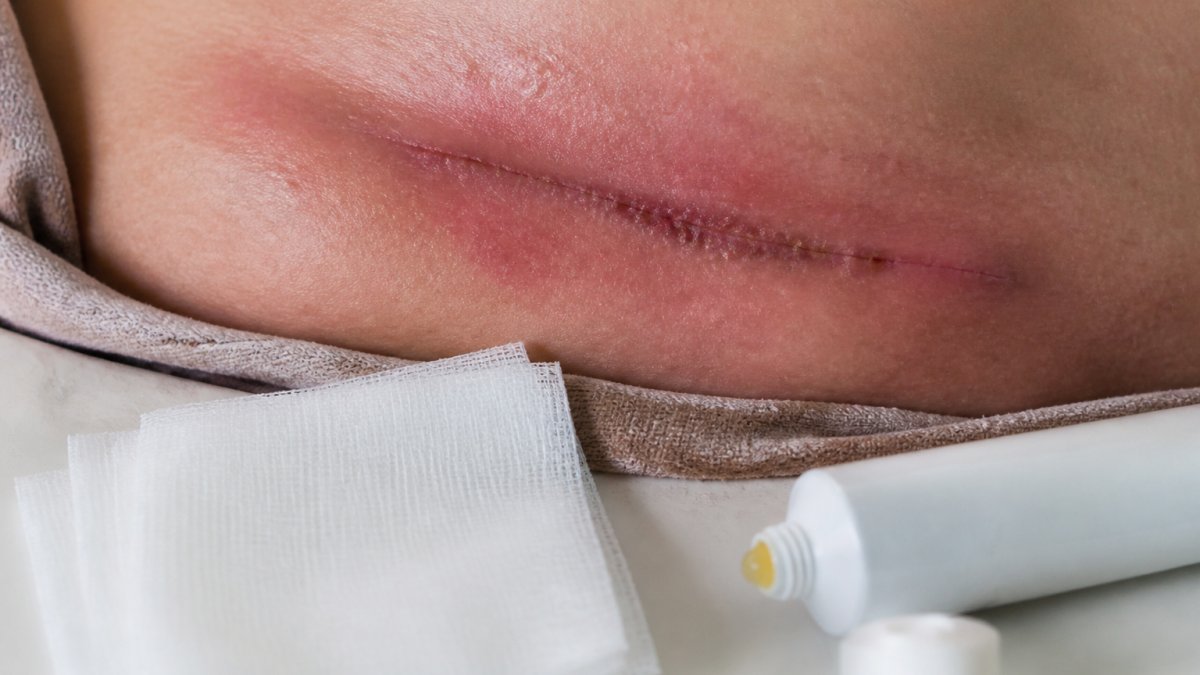 Infographic showing signs of complications after cosmetic surgery, highlighting incision redness and infection symptoms